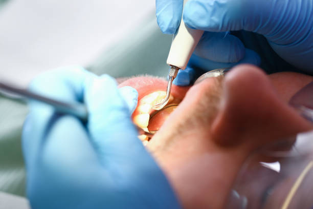 Best Emergency Treatment for Dental Infections or Abscesses in Farmville, VA